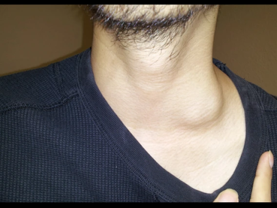 cocci_cervical_lymphadenitis_disseminated_disease_1.jpg