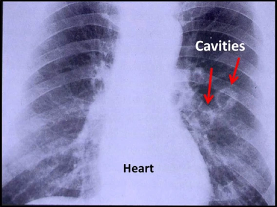 cocci_l_cavitary_pneumonia_1.jpg