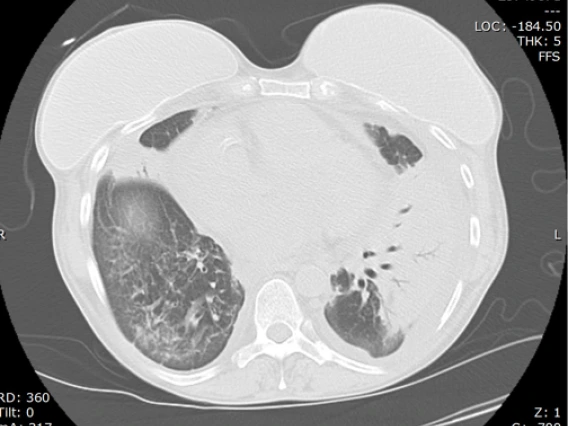 cocci_pneumonia_with_pleuropericarditis_and_breast_implants2a.jpg