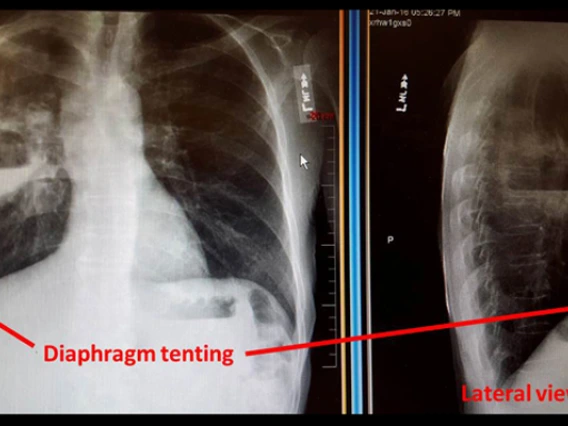 coccidioides_right_lung_abscess2.jpg