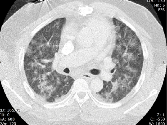 disseminated_coccidioides_infection_with_extensive_pulmonary_infiltratess_2_0.jpg