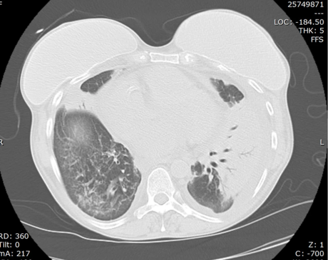 cocci_pneumonia_with_pleuropericarditis_and_breast_implants2a.jpg