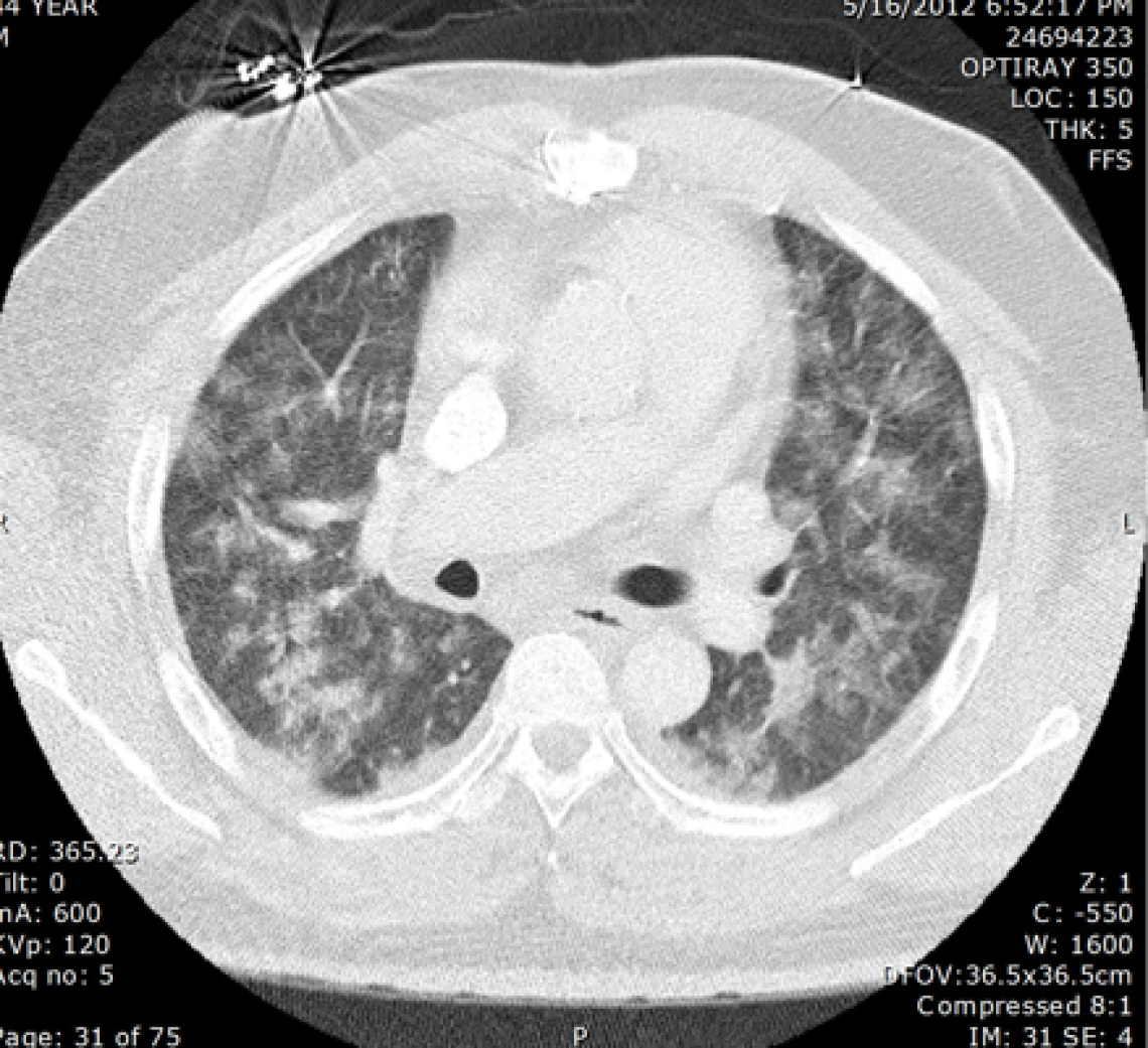 disseminated_coccidioides_infection_with_extensive_pulmonary_infiltratess_2_0.jpg