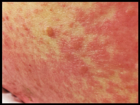 erythema_multiforme5.jpg